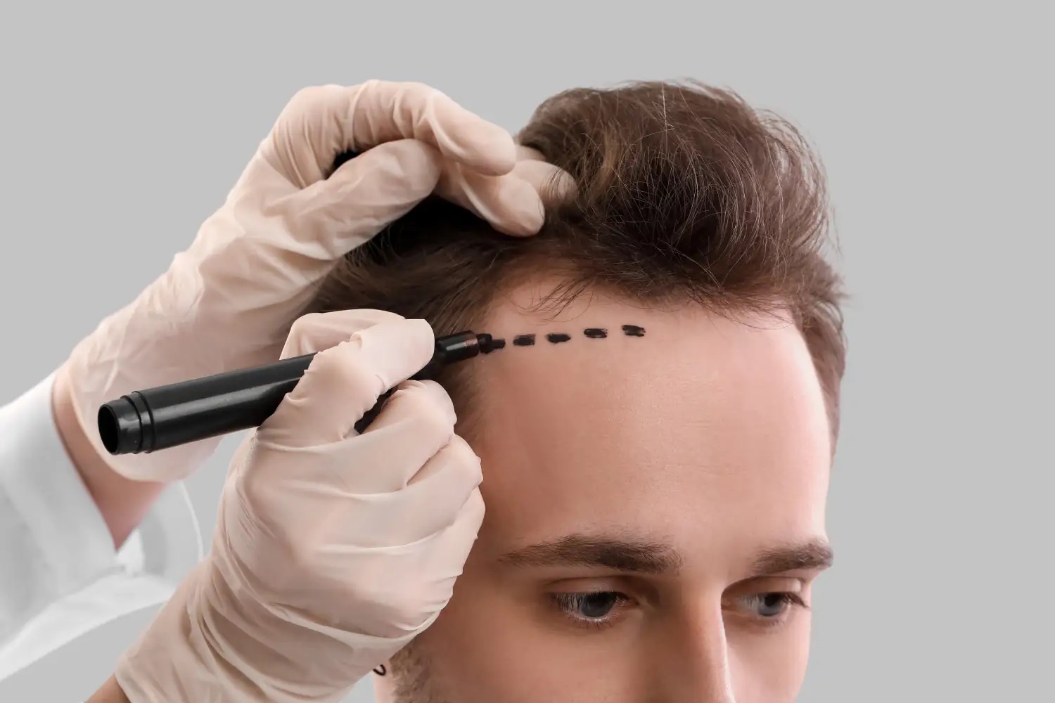 Hair Transplant Brisbane 1
